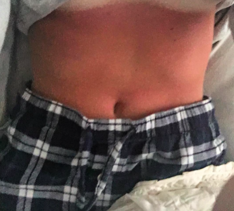 This is what happens when you don't put on sunscreen at all!
